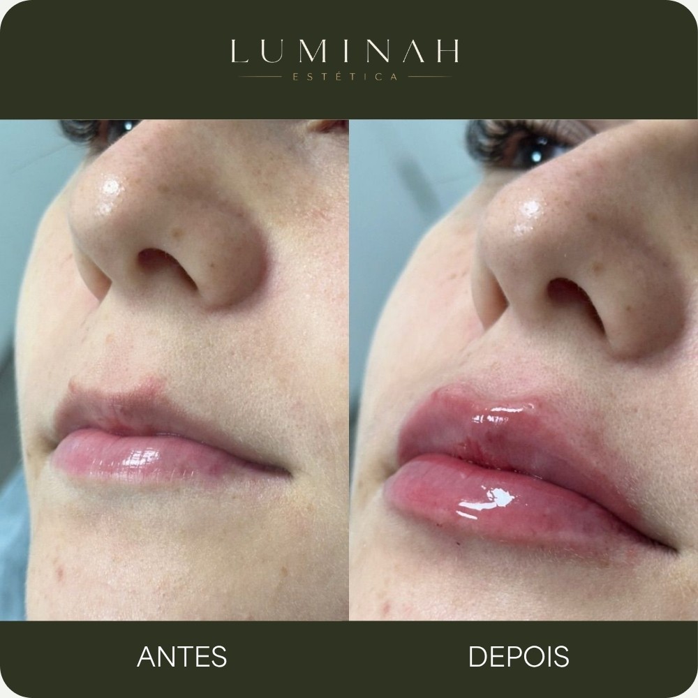 Preenchimento Labial