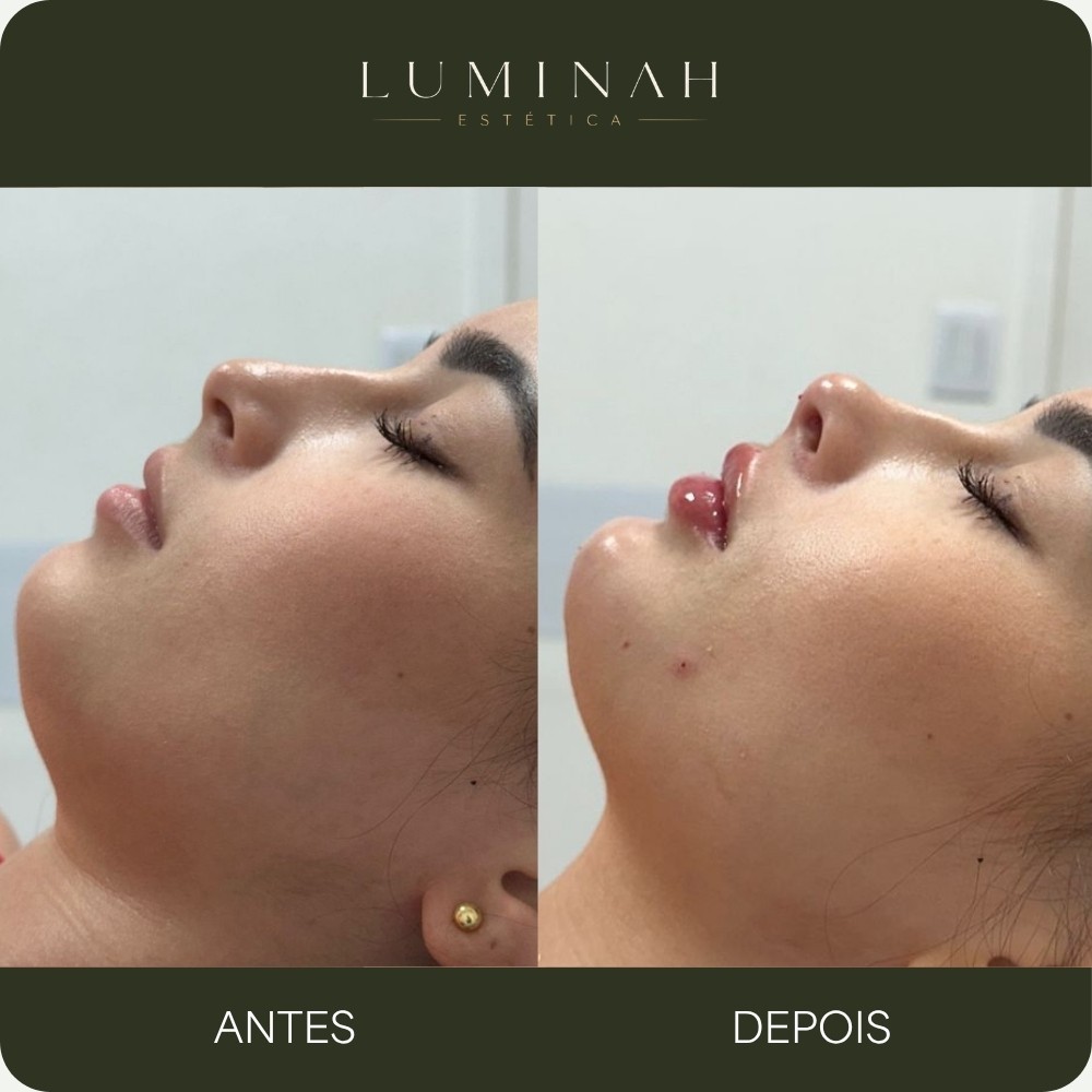 Harmonização facial