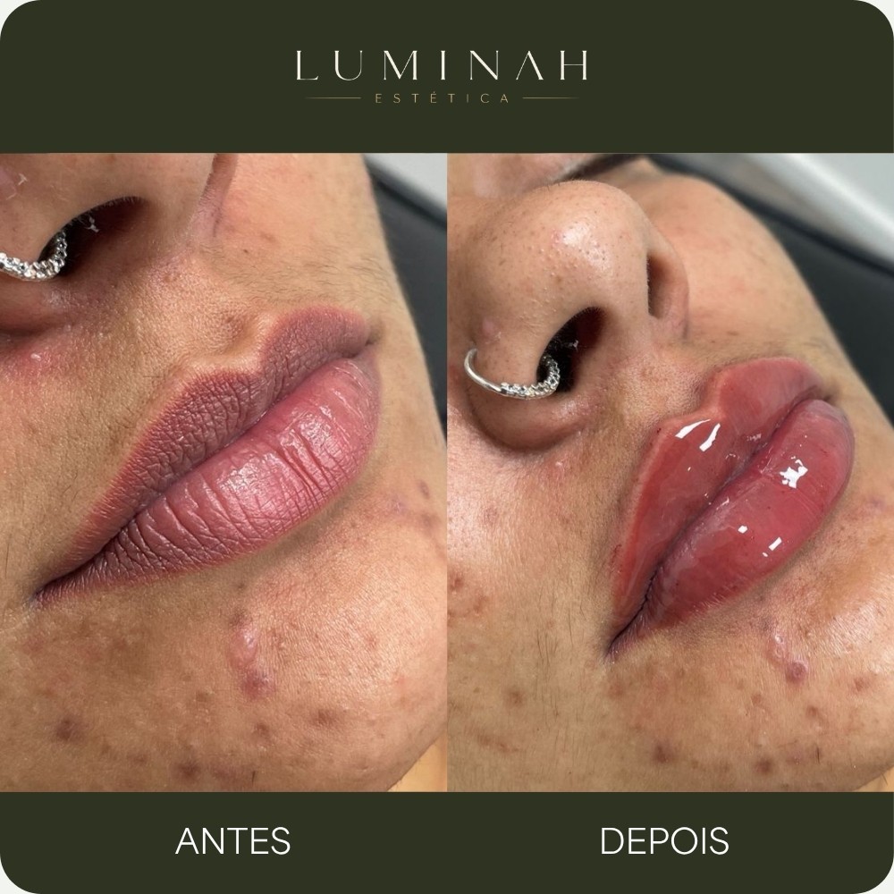 Preenchimento labial