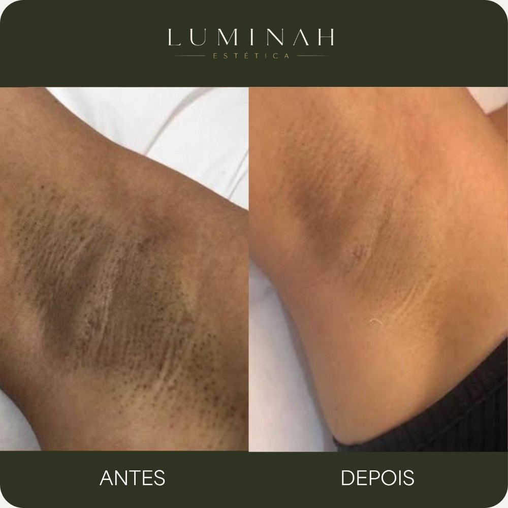 Depilação a laser