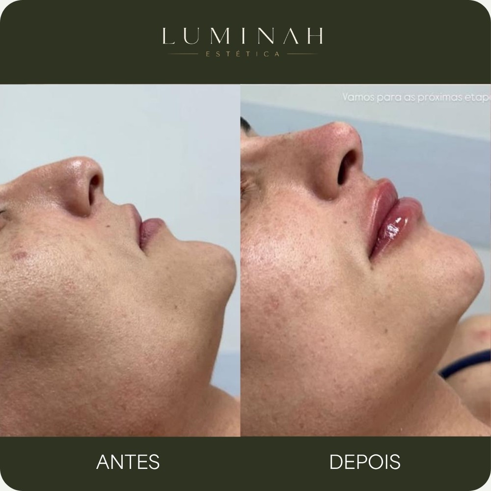 Harmonização facial