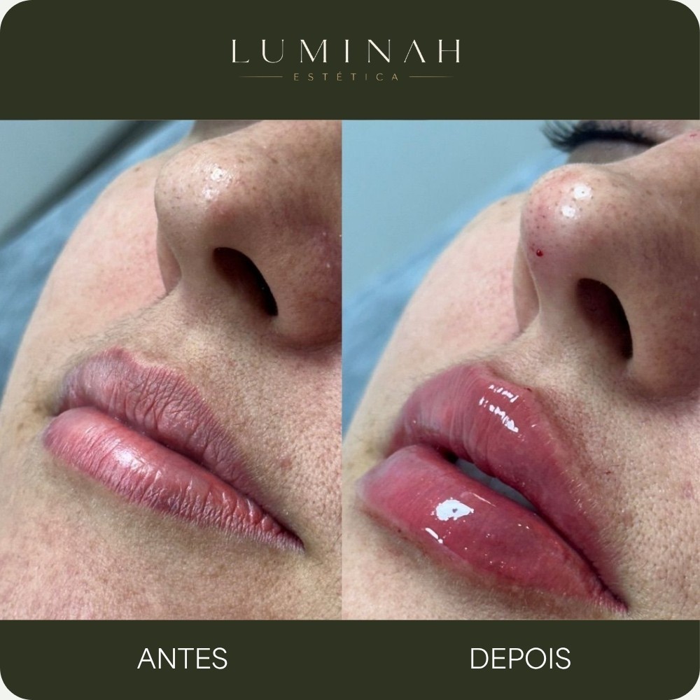 Preenchimento labial